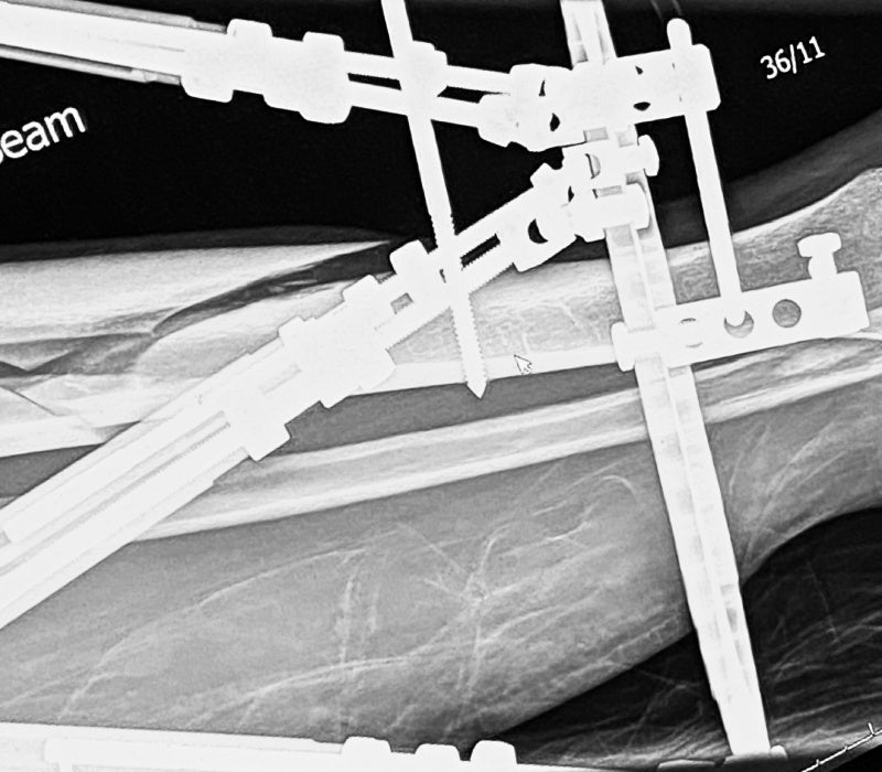 Injury to Ironman: how Wattbike Atom is aiding one Wattbiker's road to recovery